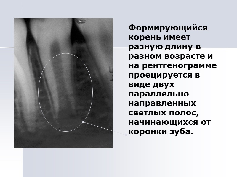 Формирующийся корень имеет разную длину в разном возрасте и на рентгенограмме проецируется в виде